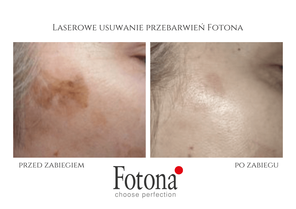 Laser pigmentation removal — before and after result, Velvet Skin Clinic Warsaw