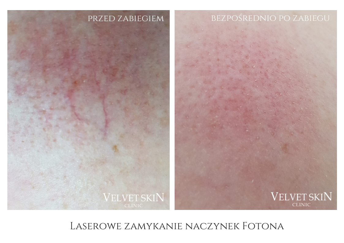 Laser treatment for broken capillaries and redness — before and after the treatment, Velvet Skin Clinic Warsaw