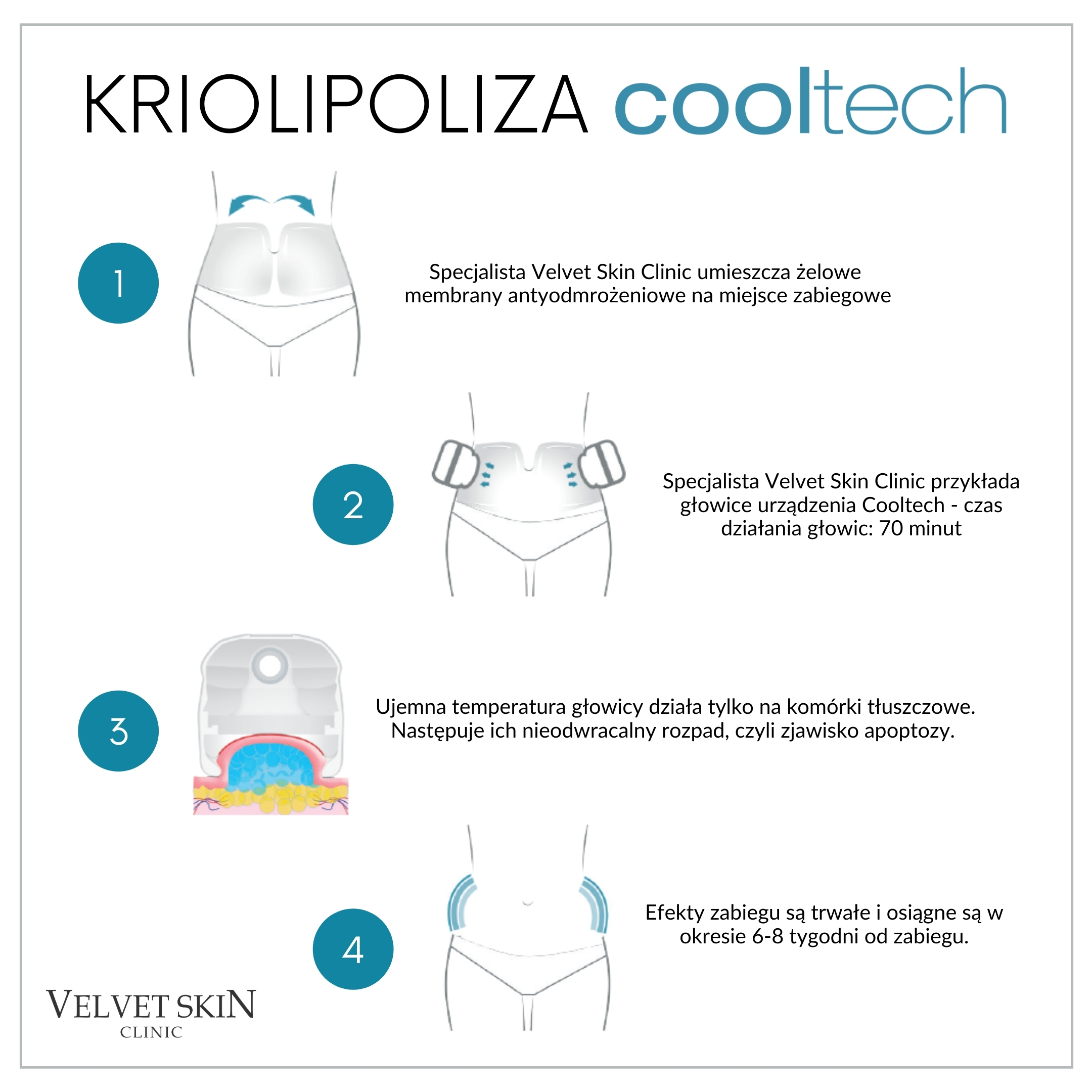 Cooltech cryolipolysis — treatment stages (infographic)