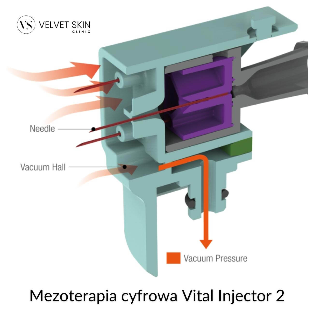 Vital Injector 2 Mesotherapy — Vital Injector 2 Vacuum Mesotherapy Technology