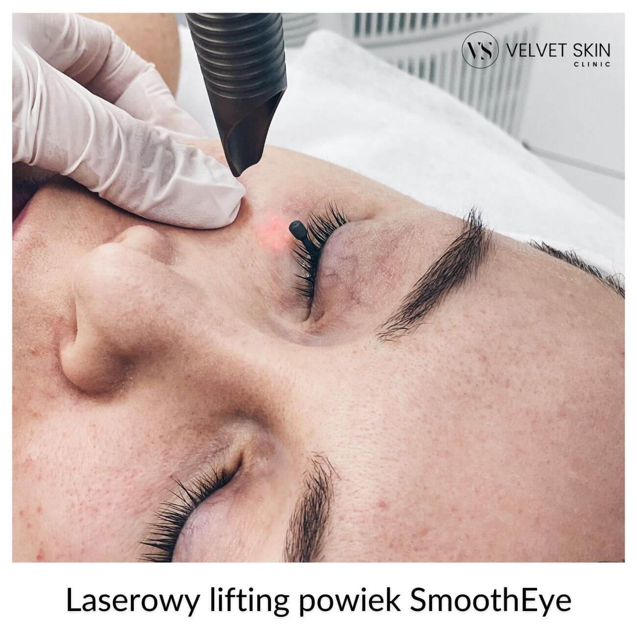 Laserowy lifting powiek SmoothEye &mdash; etap 3 terapii 3-Step Eye Lift