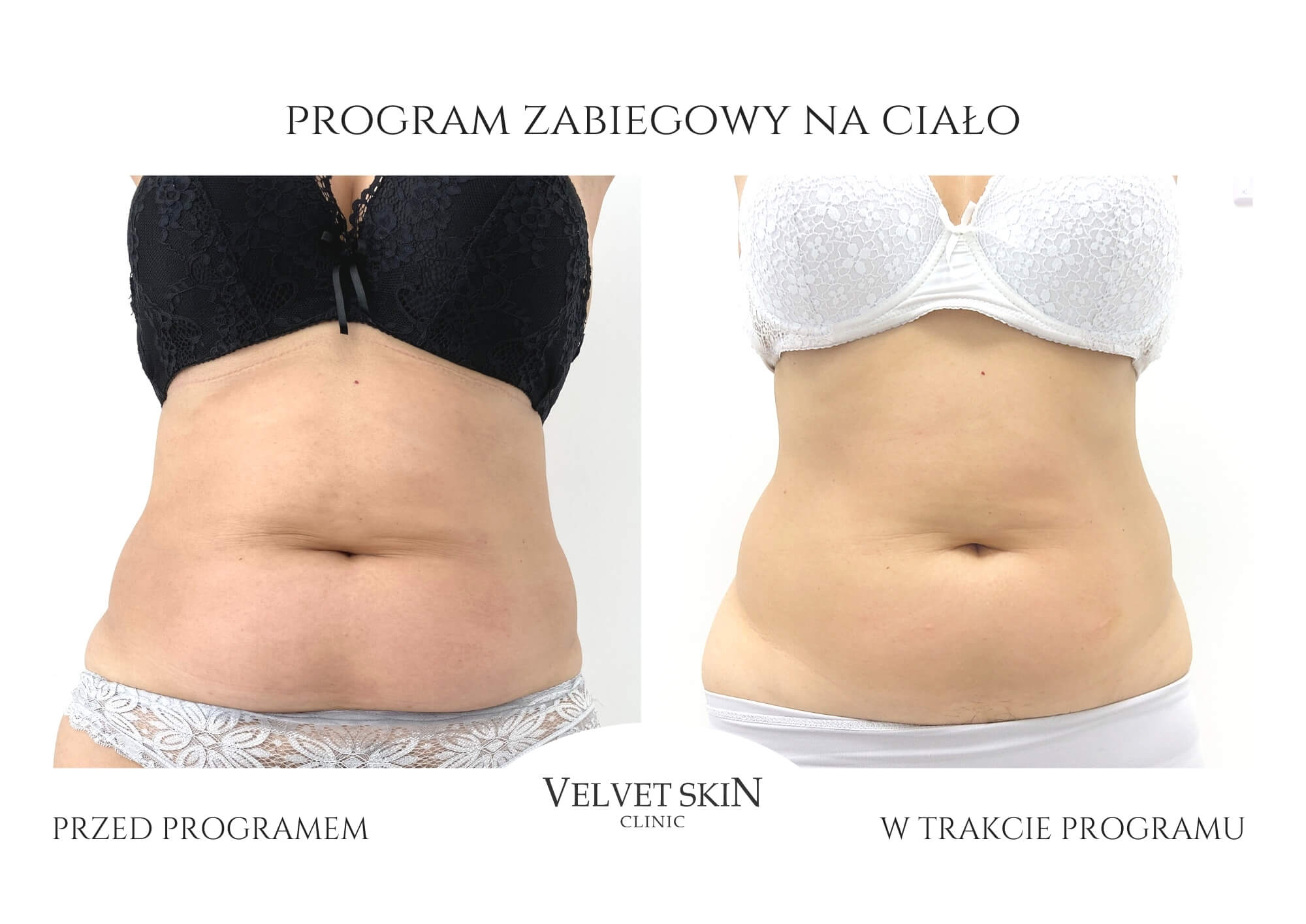 Autorski program zabiegowy Jędrna Pupa — Velvet Skin Clinic