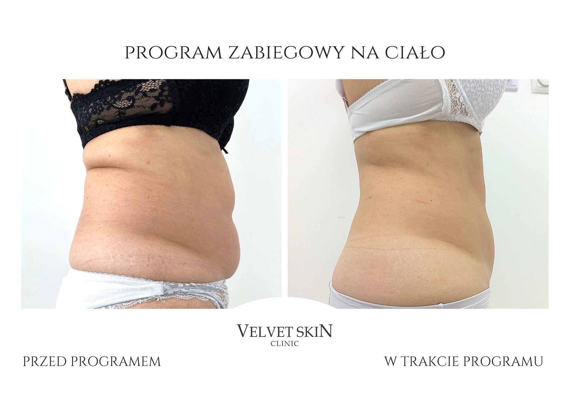 Autorski program zabiegowy Jędrna Pupa — Velvet Skin Clinic