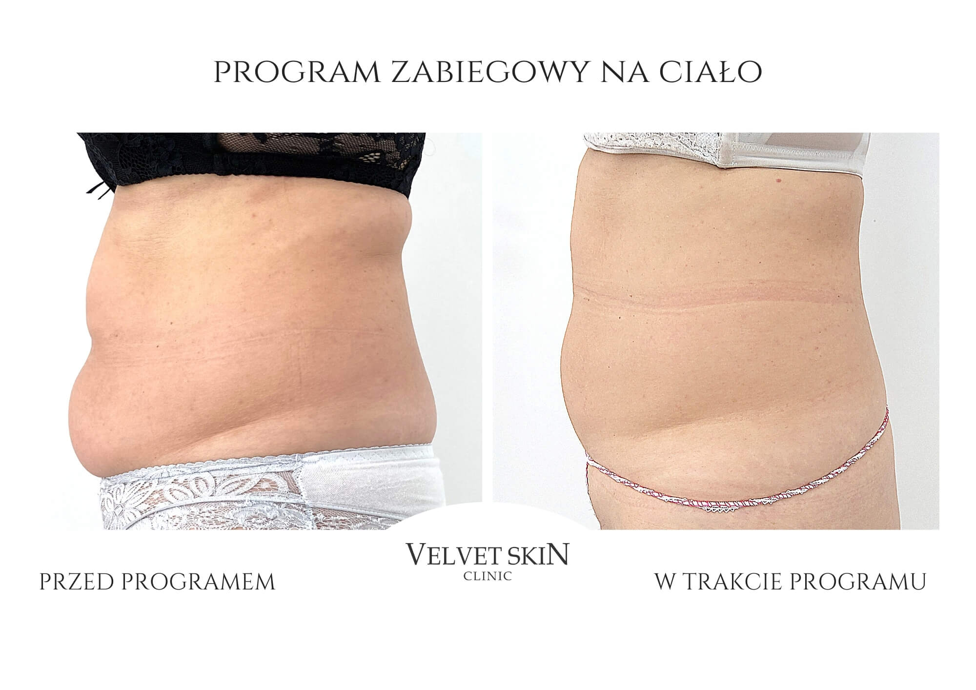 Autorski program zabiegowy Jędrna Pupa — Velvet Skin Clinic
