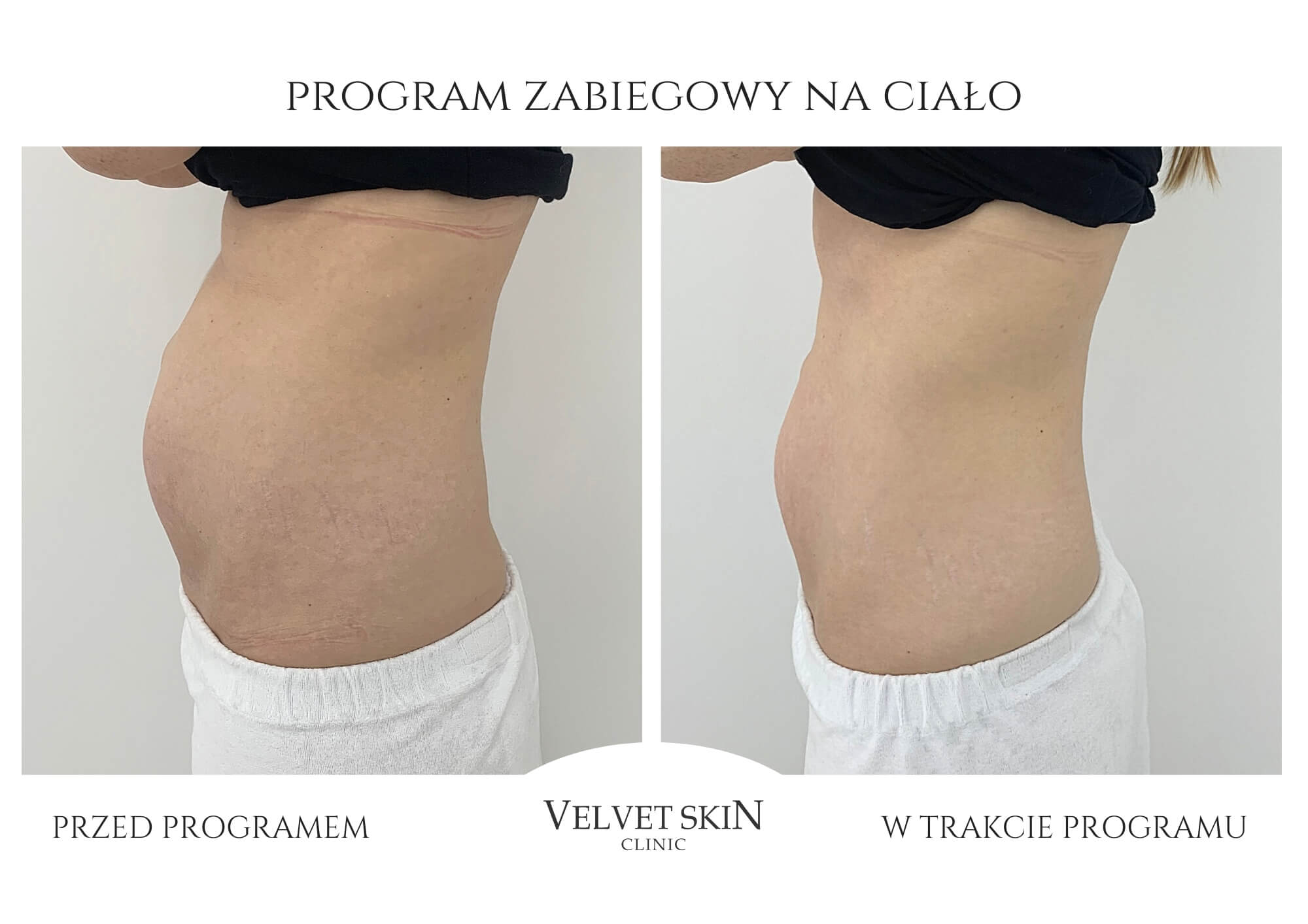 Autorski program zabiegowy Jędrna Pupa — Velvet Skin Clinic
