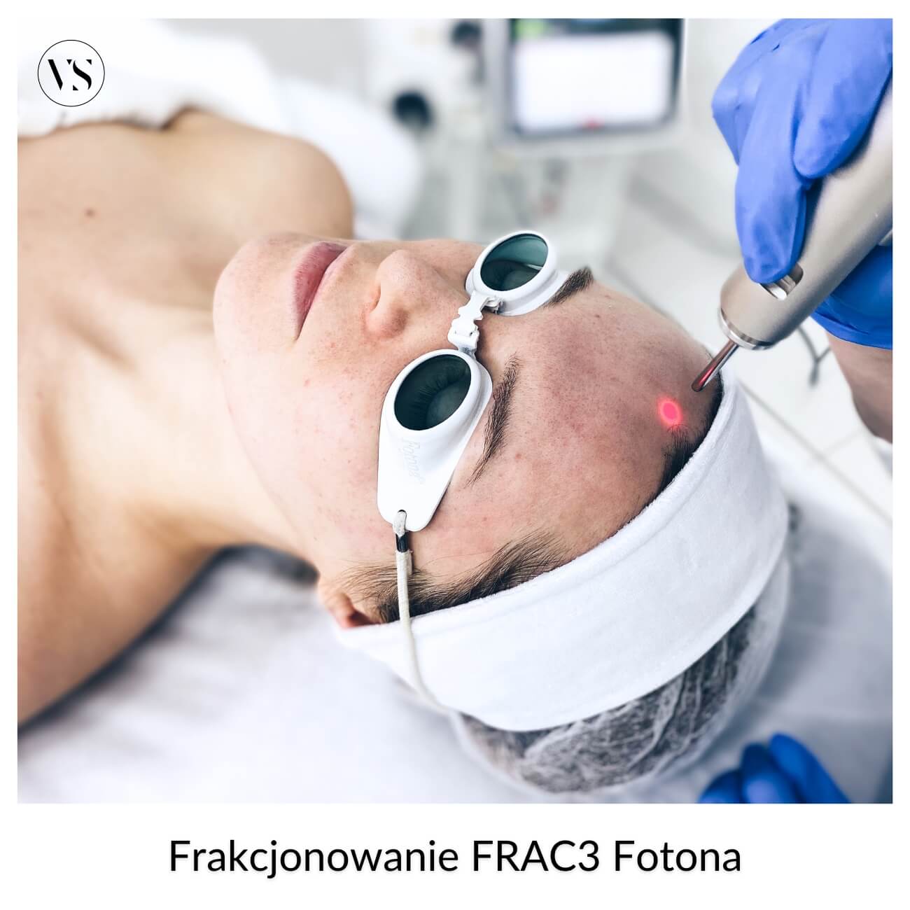 Frakcjonowanie 3D FRAC3 laserem Fotona, etap 3 terapii 5-step Instant Lift