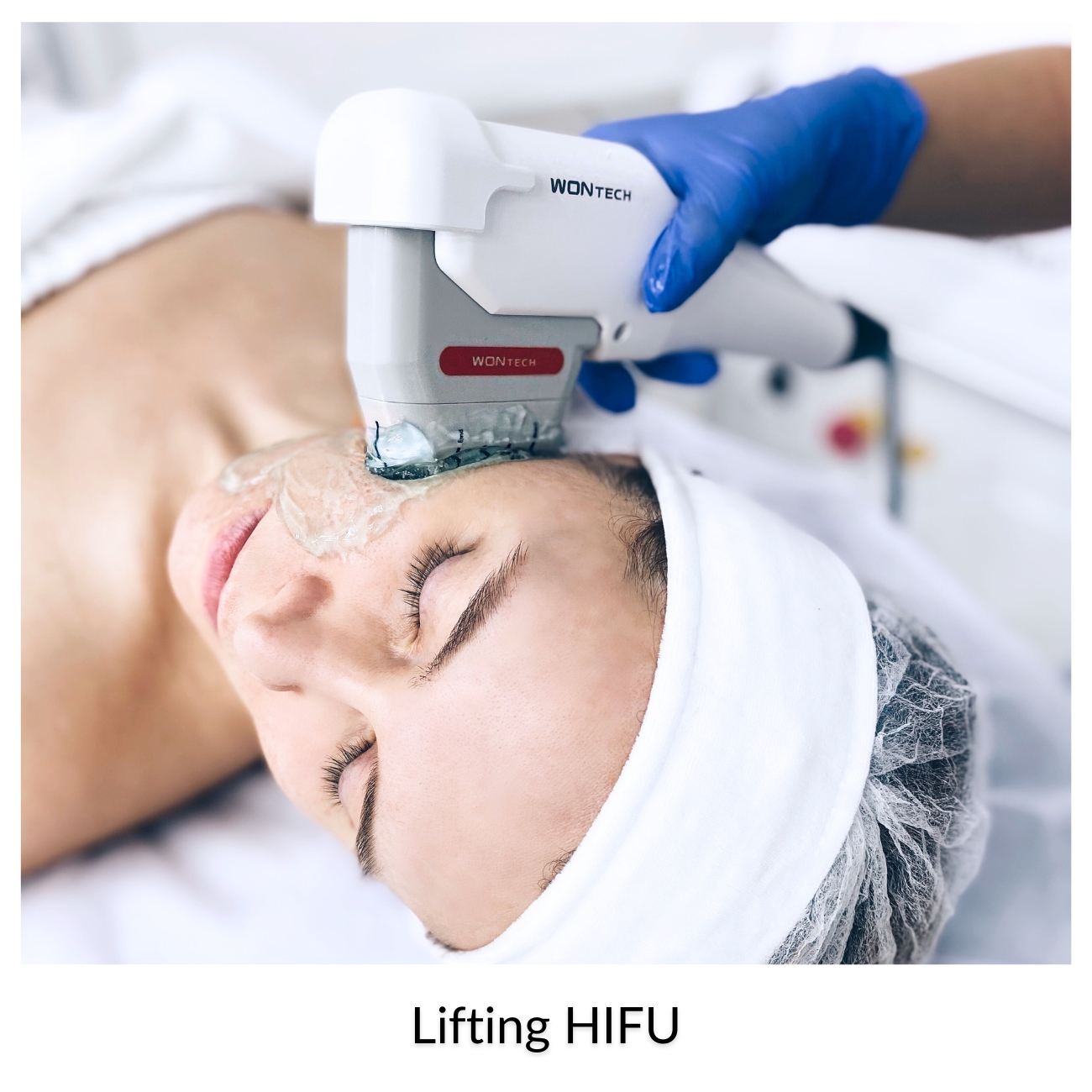 Lifting HIFU w warstwie SMAS — terapia 5-step Instant Lift w Velvet Skin Clinic