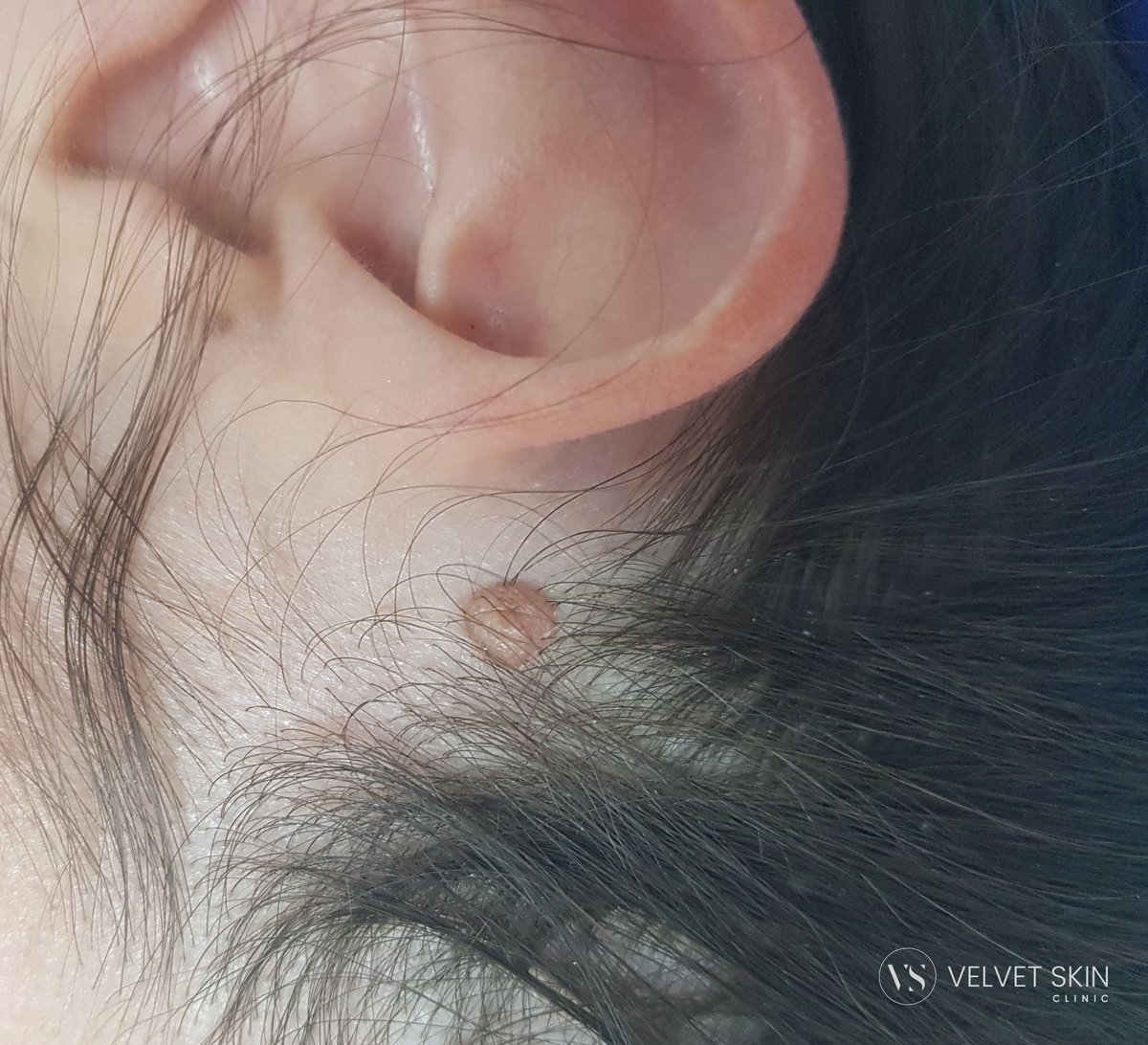 Seborrhoeic keratosis along the hairline before laser removal. Velvet Skin Clinic Warsaw