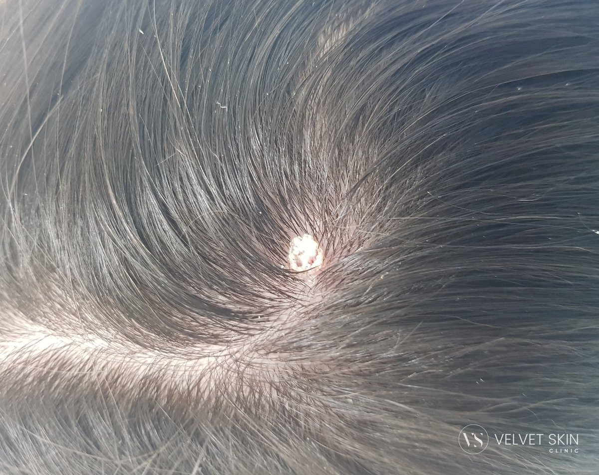 The area on the scalp right after lesion removal — visible scab. Velvet Skin Clinic Warsaw