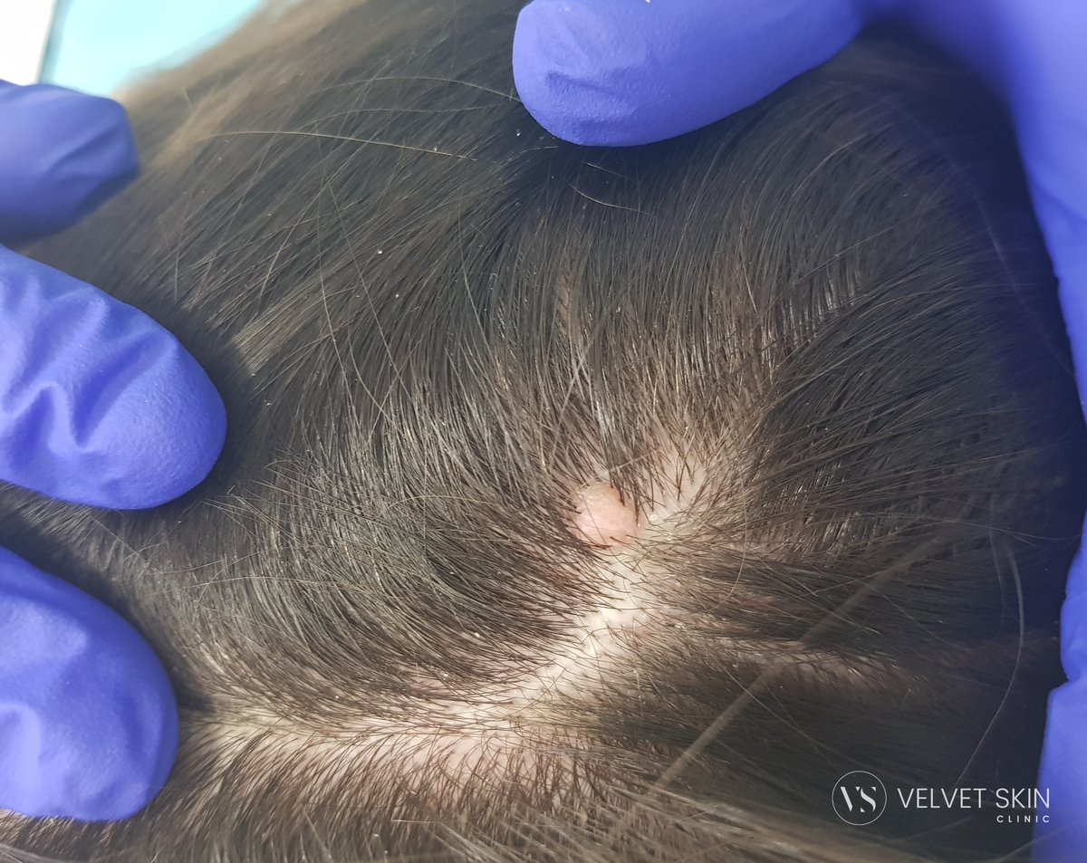 Seborrhoeic keratosis on the scalp before laser treatment. Velvet Skin Clinic Warsaw